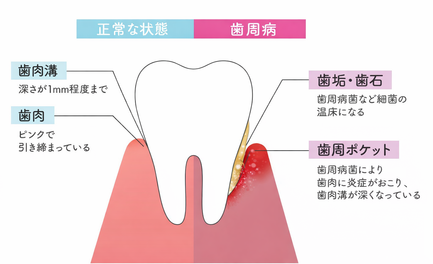 歯周病の炎症イメージ