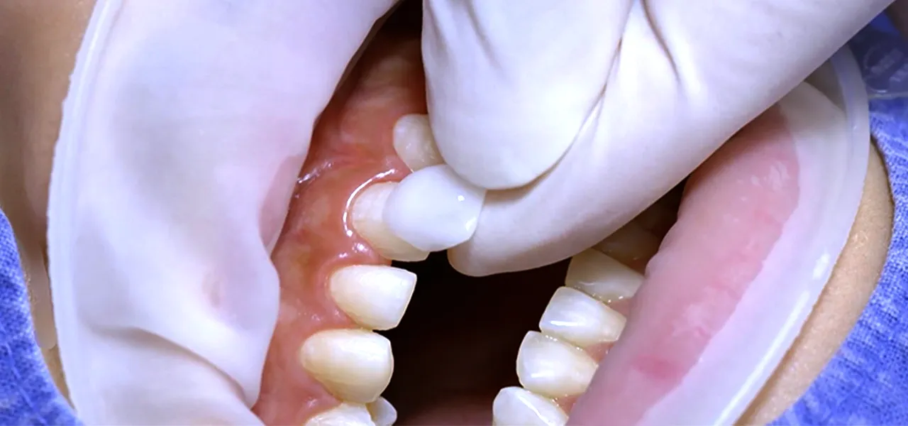 MINISH（ラミネートベニア）イメージ